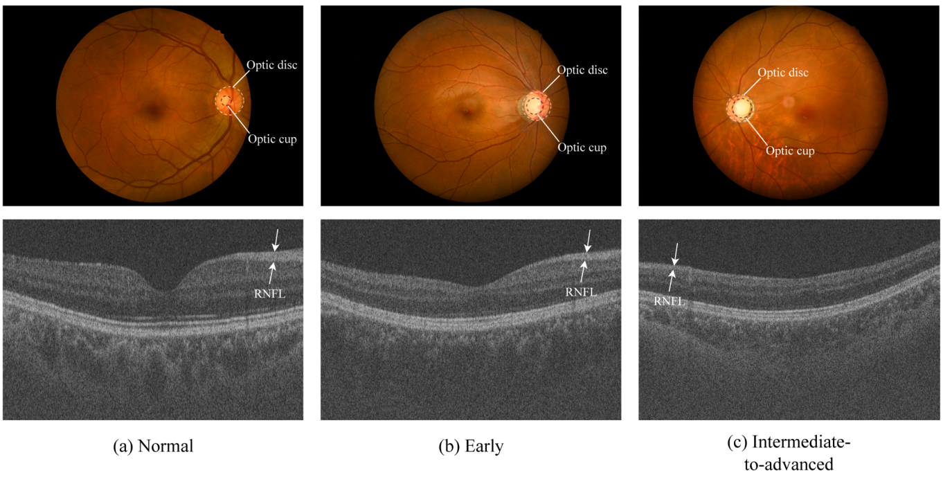 Examples from the GAMMA dataset across three glaucoma severity stages